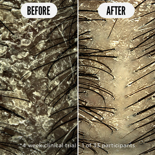 Gevoelige Hoofdhuid Starter Bundel 